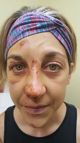Kori with wounds on her face and grief inside as she realizes how much diet culture robbed from her life